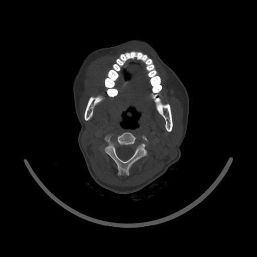 Carcinoma of the maxillary antrum (Radiopaedia 53805-59888 Axial bone window 85).jpg