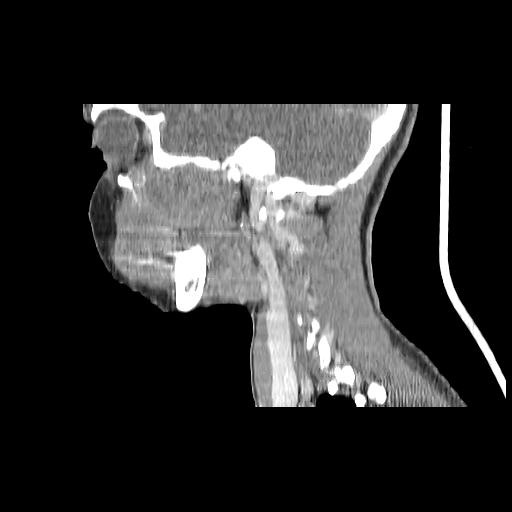 Carcinoma of the maxillary antrum (Radiopaedia 53805-59888 Sagittal C+ delayed 60).jpg