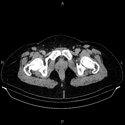 File:Carcinoma of uterine cervix (Radiopaedia 85861-101700 Axial C+ delayed 91).jpg