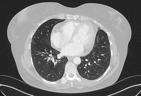 Cardiac sarcoidosis (Radiopaedia 74548-85534 Axial lung window 57).jpg