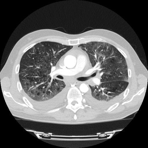 Cardiac tamponade (Radiopaedia 78607-91368 Axial lung window 36).jpg