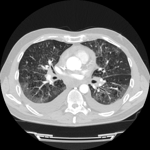 Cardiac tamponade (Radiopaedia 78607-91368 Axial lung window 44).jpg