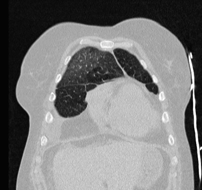 Cardiogenic pulmonary edema (Radiopaedia 29213-29609 Coronal lung window 11).jpg