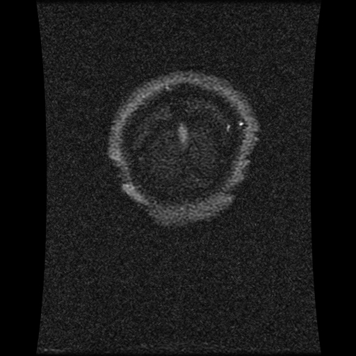 Carotid arterial dissection with acute cerebral infarction (Radiopaedia 26636-26784 MRV 31).jpg