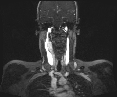Carotid body tumor (Radiopaedia 12777-12912 MRA 38).jpg