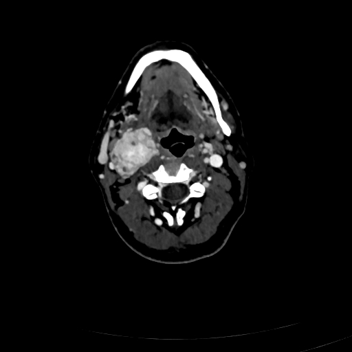 Carotid body tumor (Radiopaedia 83615-98727 D 55).jpg