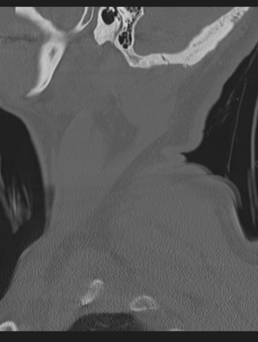 Cavernoma of cervical cord (Radiopaedia 50838-56346 Sagittal bone window 6).png