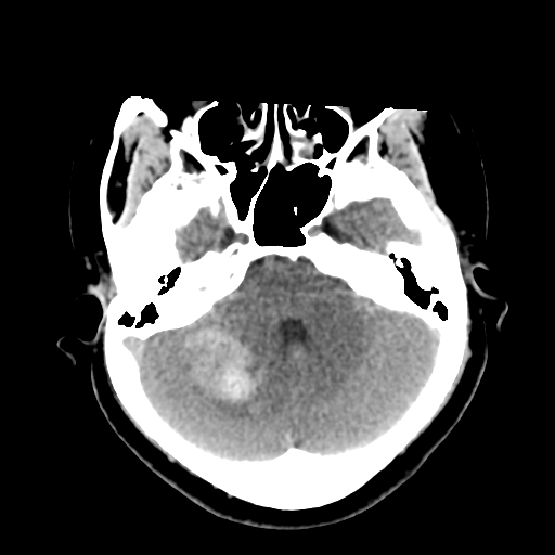 Cavernoma with hemorrhage (Radiopaedia 70755-80931 Axial non-contrast 15).png