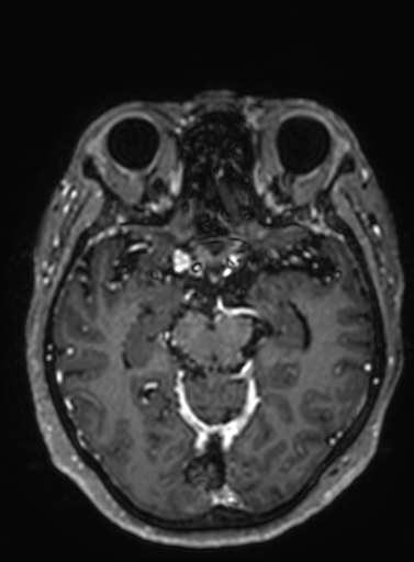 Cavernous hemangioma of the cerebellar falx (Radiopaedia 73025-83724 Axial T1 C+ 204).jpg
