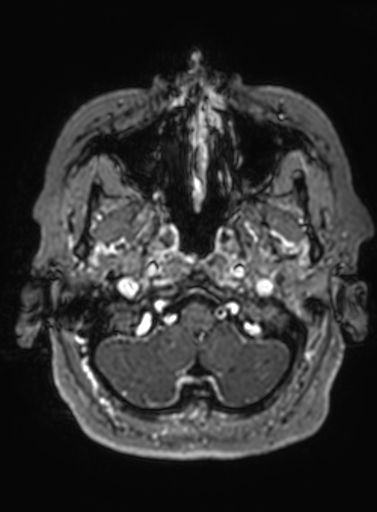 Cavernous hemangioma of the cerebellar falx (Radiopaedia 73025-83724 Axial T1 C+ 304).jpg