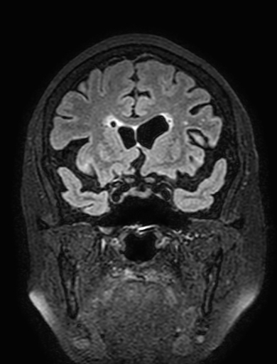 Cavernous hemangioma of the cerebellar falx (Radiopaedia 73025-83724 Coronal FLAIR 115).jpg