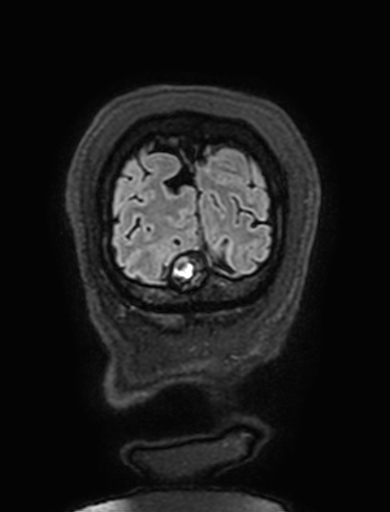Cavernous hemangioma of the cerebellar falx (Radiopaedia 73025-83724 Coronal FLAIR 334).jpg