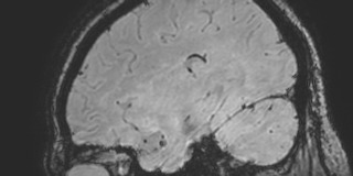 Cavernous hemangioma of the cerebellar falx (Radiopaedia 73025-83724 Sagittal BOLD 51).jpg