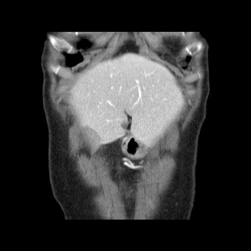 Cavernous hepatic hemangioma (Radiopaedia 75441-86667 C 25).jpg