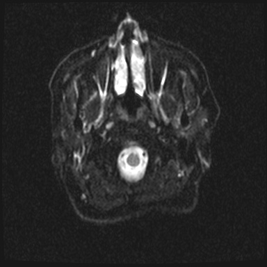 Cavernous sinus meningioma (Radiopaedia 63682-72367 DWI 2).jpg