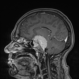 Cavernous sinus meningioma (Radiopaedia 63682-72367 Sagittal T1 C+ 84).jpg