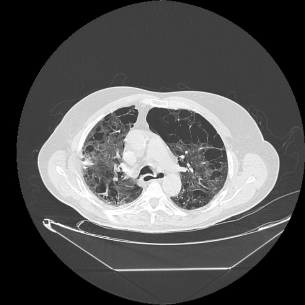 Cavitating bronchogenic carcinoma (Radiopaedia 44489-48162 Axial lung window 30).jpg