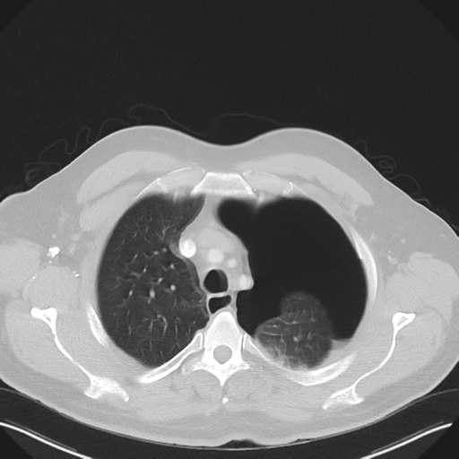 Cavitating pneumonia complicated by pneumothorax (Radiopaedia 48149-52994 Axial lung window 15).png