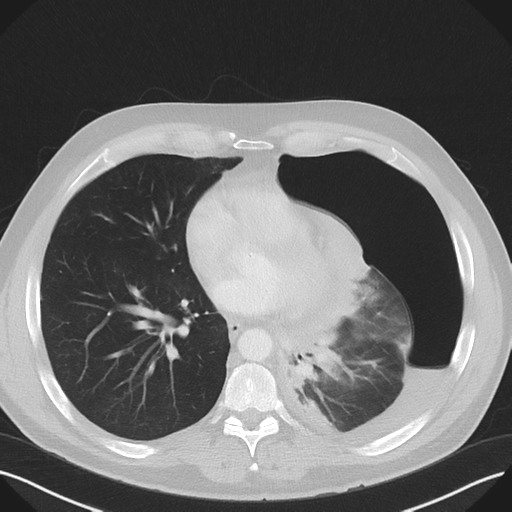 File:Cavitating pneumonia complicated by pneumothorax (Radiopaedia 48149-52994 Axial lung window 42).png