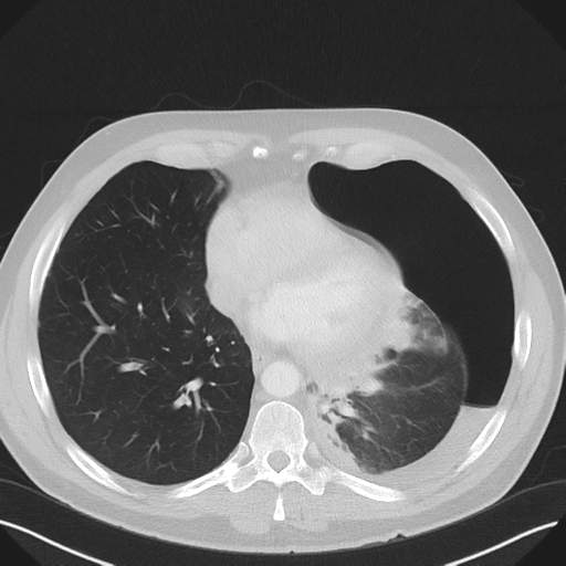 File:Cavitating pneumonia complicated by pneumothorax (Radiopaedia 48149-52994 Axial lung window 45).png