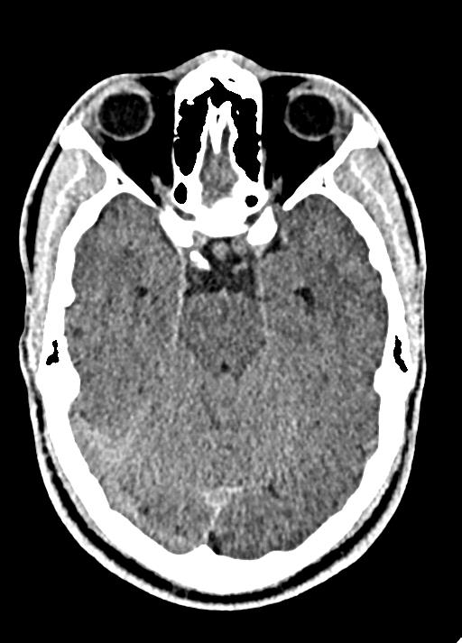 Cavum septum pellucidum and cavum vergae (Radiopaedia 77797-90060 Axial Brain Window 37).jpg