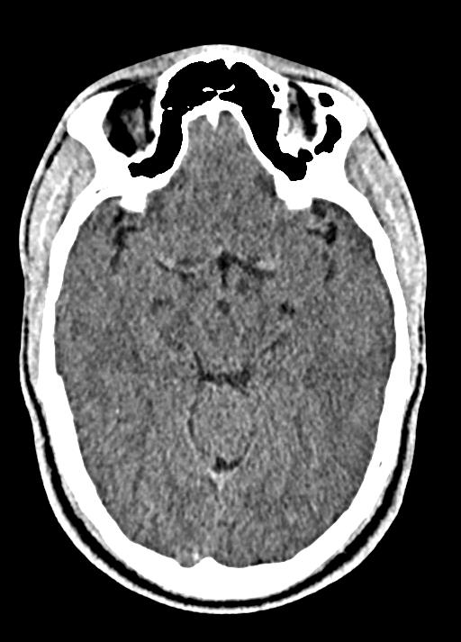Cavum septum pellucidum and cavum vergae (Radiopaedia 77797-90060 Axial Brain Window 43).jpg