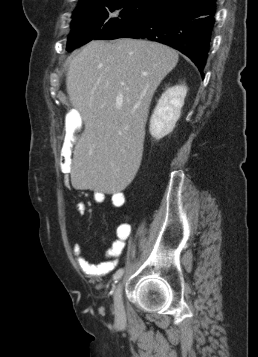 Cecal adenocarcinoma - surgical scar recurrence (Radiopaedia 79988-93264 D 48).jpg