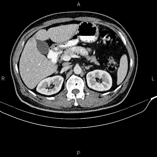 Cecal cancer with appendiceal mucocele (Radiopaedia 91080-108651 B 37).jpg