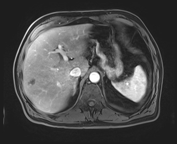 Cecal mass causing appendicitis (Radiopaedia 59207-66532 H 36).jpg