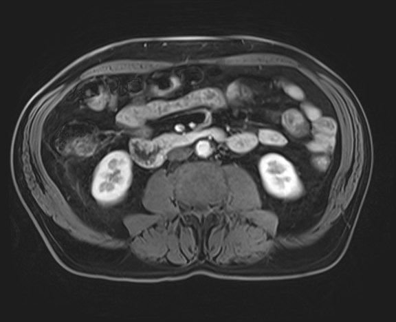 Cecal mass causing appendicitis (Radiopaedia 59207-66532 H 73).jpg