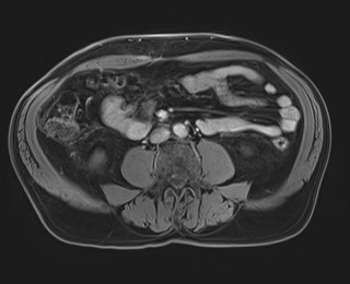 Cecal mass causing appendicitis (Radiopaedia 59207-66532 T1 C+ PV phase 79).jpg
