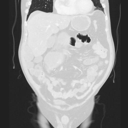 Cecal volvulus (Radiopaedia 75378-86620 Coronal lung window 58).jpg