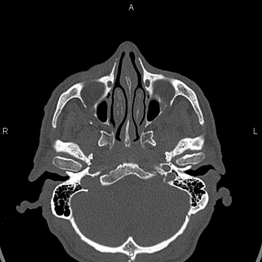 File:Central giant cell granuloma (Radiopaedia 83346-97761 Axial bone window 44).jpg
