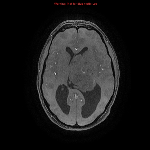 Central neurocytoma (Radiopaedia 13188-13206 Axial MRA 40).jpg