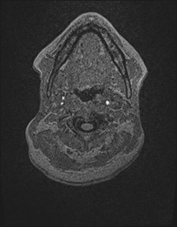 Central neurocytoma (Radiopaedia 84497-99872 Axial T1 1).jpg