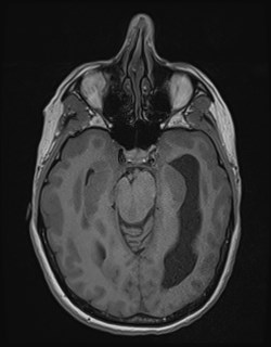Central neurocytoma (Radiopaedia 84497-99872 Axial T1 77).jpg