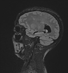 File:Central neurocytoma (Radiopaedia 84497-99872 Sagittal Flair + Gd 49).jpg