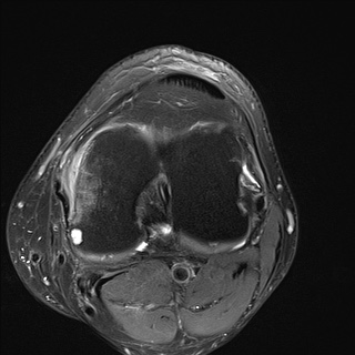 File:Central osteophyte (Radiopaedia 72592-83151 Axial PD fat sat 18).jpg