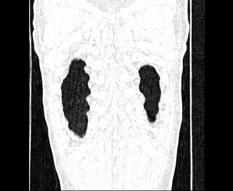 Centrilobular pulmonary emphysema (Radiopaedia 62468-70718 Coronal lung window 69).jpg
