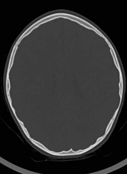 File:Cerebellar abscess (Radiopaedia 73727-84527 Axial bone window 44).jpg