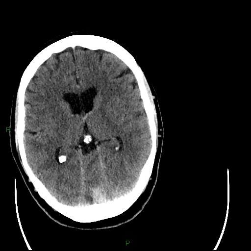 Cerebellar abscess (Radiopaedia 78135-90671 Axial C+ delayed 56).jpg
