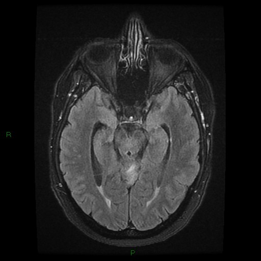 File:Cerebellar abscess (Radiopaedia 78135-90678 Axial FLAIR 13).jpg