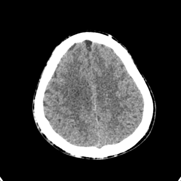 Cerebellar abscess secondary to mastoiditis (Radiopaedia 26284-26412 Axial non-contrast 127).jpg