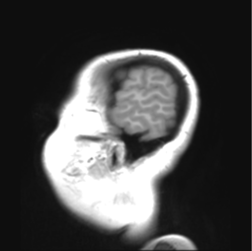 File:Cerebellar ependymoma complicated by post-operative subdural hematoma (Radiopaedia 83322-97736 Sagittal T1 4).png