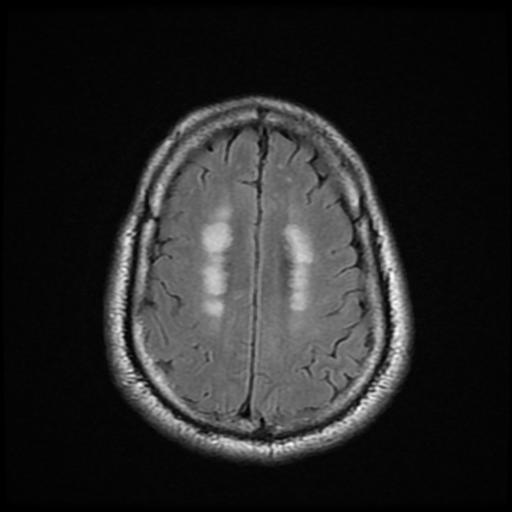File:Cerebellar hemangioblastoma (Radiopaedia 88055-104622 Axial FLAIR 20).jpg