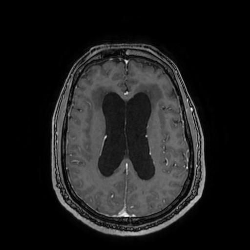 File:Cerebellar hemangioblastoma (Radiopaedia 88055-104622 Axial T1 C+ 112).jpg
