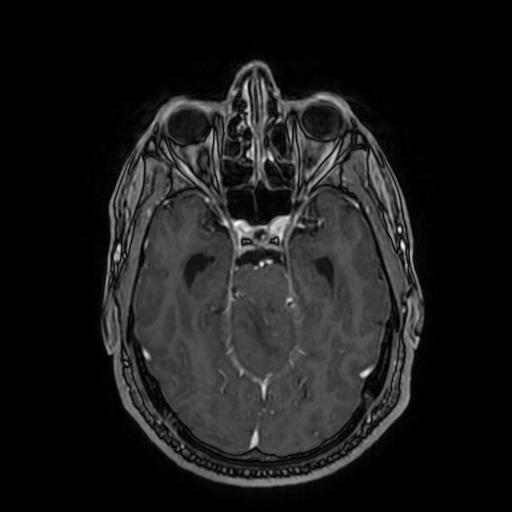 Cerebellar hemangioblastoma (Radiopaedia 88055-104622 Axial T1 C+ 74).jpg