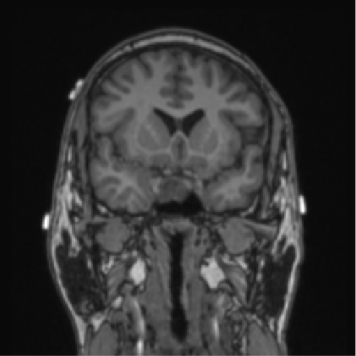 File:Cerebellar hemangioblastomas and pituitary adenoma (Radiopaedia 85490-101176 Coronal T1 59).png
