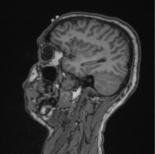 Cerebellar hemangioblastomas and pituitary adenoma (Radiopaedia 85490-101176 Sagittal T1 69).png