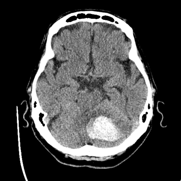 Cerebellar hemorrhage (Radiopaedia 27193-27359 Axial non-contrast 16).jpg